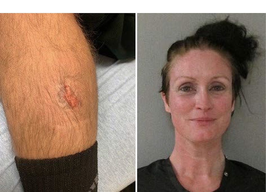Left: The bite broke the skin. Right: Cherie Saunders. Photos courtesy of the FCSO