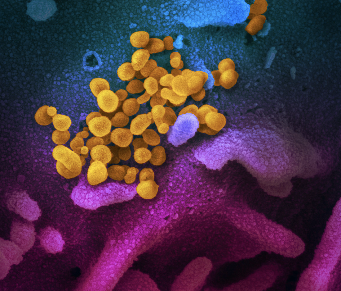 A scanning electron microscope image of COVID-19 from a U.S. patient. Image by the NIH National Institute of Allergy and Infectious Diseases. See more at https://bit.ly/2IO4feI.