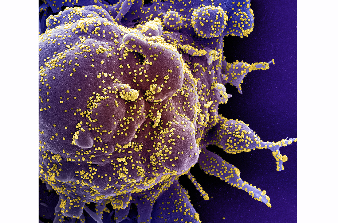 A colorized scanning electron micrograph of a cell infected with SARS-CoV-2, the virus that causes COVID-19. Image courtesy of the National Institute of Allergy and Infectious Diseases