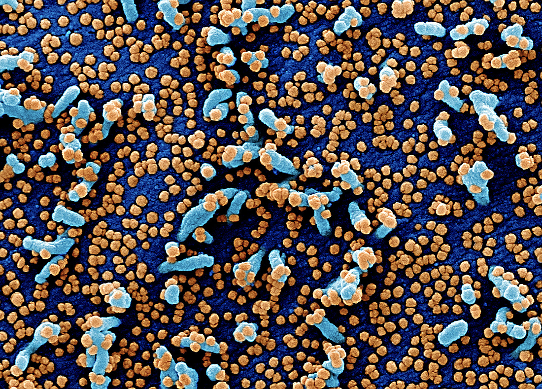 A colorized scanning electron micrograph of a cell infected with SARS-COV-2 virus particles (orange). Image courtesy of the National Institute of Allergy and Infectious Diseases