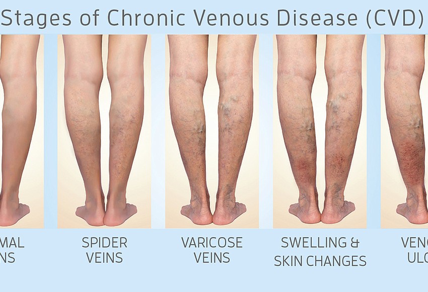 Sponsored: Stages of Vein Disease: What Stage Am I?