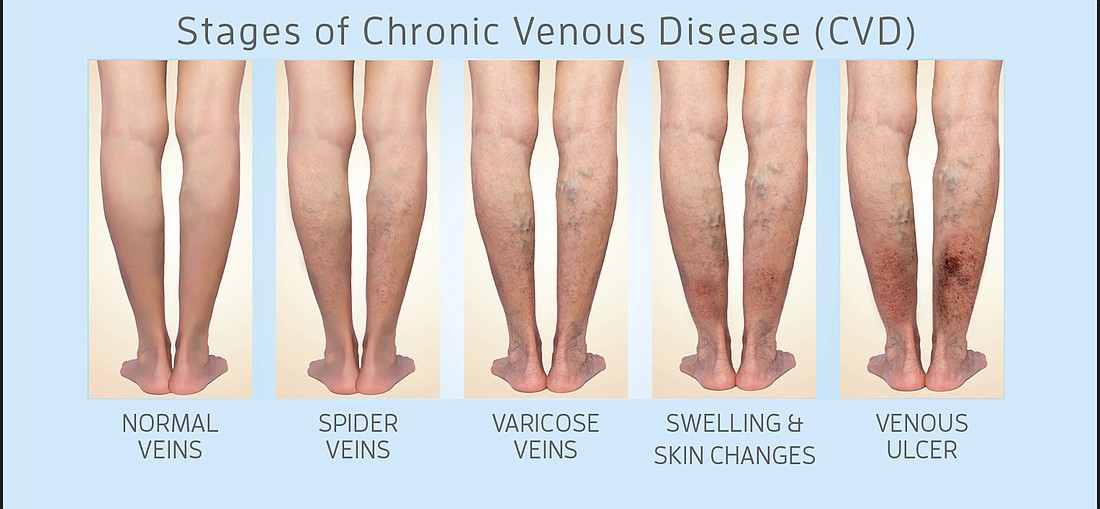 Spider Veins Are A Sign Of A Deeper Vascular Disease