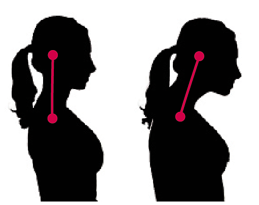 Correct posture (left) vs. â€œchicken headâ€ (right) is posture, which is a forward tilt of your neck.
