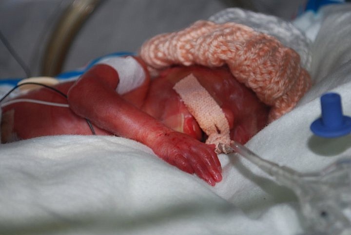 Marysa LaFontaine weighed 1 pound, 7 ounces when she was born Feb. 24, 2011.