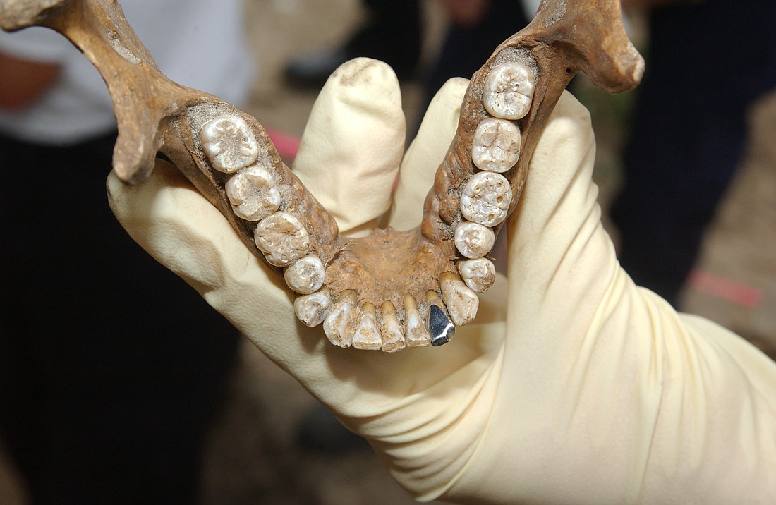 The lower jaw of the unidentified subject contained a silver tooth, which may be one of the biggest indicators when identifying the victim.