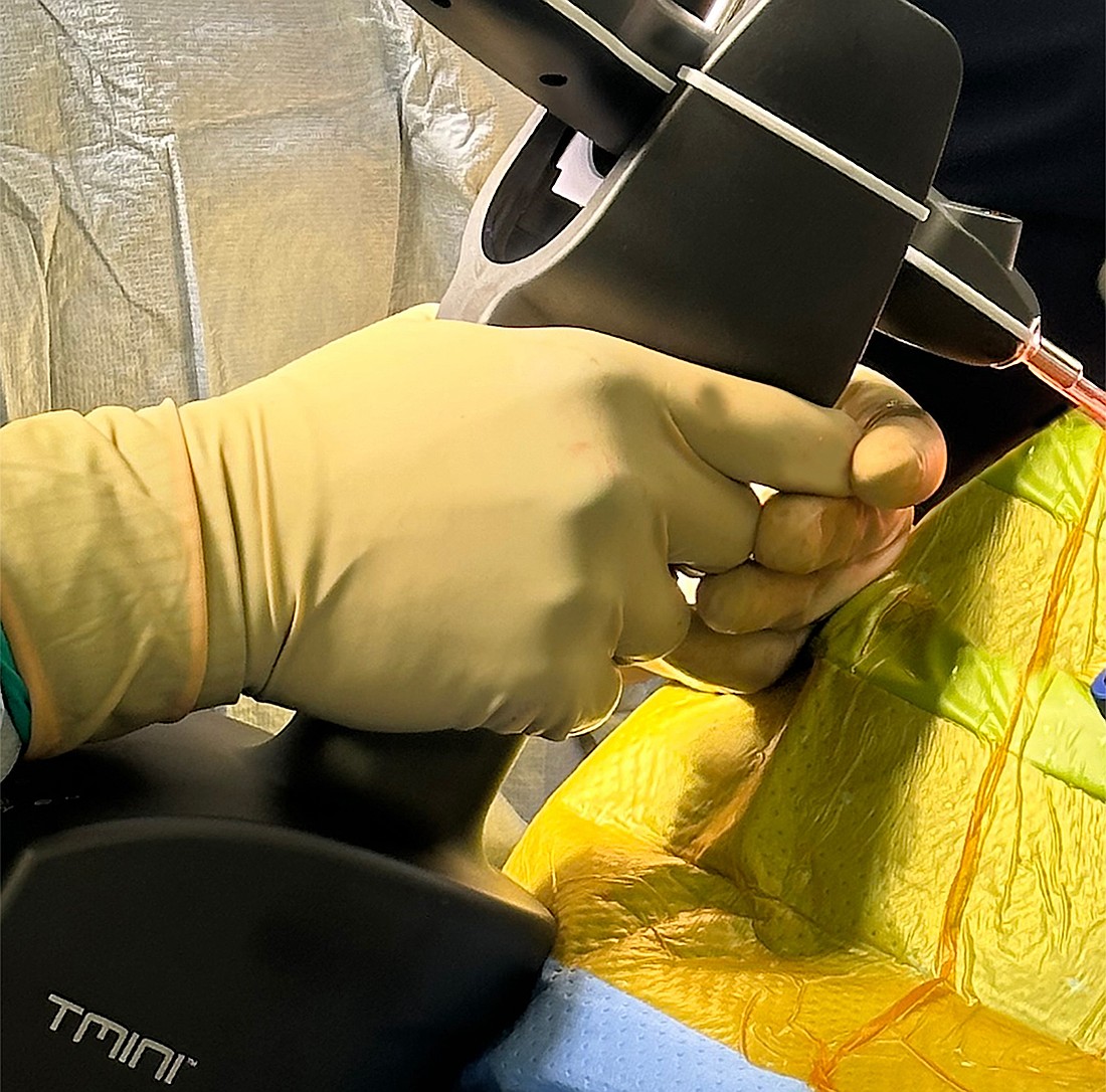 The TMINI hand-held robotic system is now in use at Sarasota Memorial Hospital for knee replacement procedures.