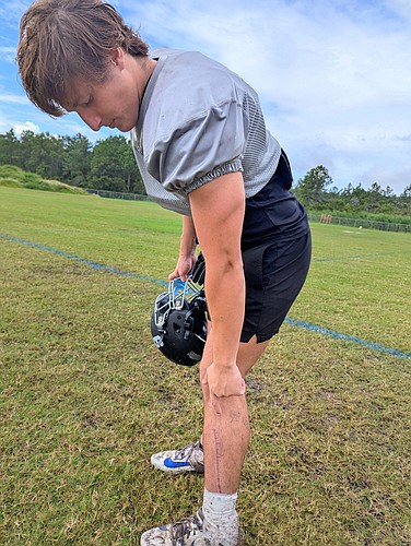Jack Ferguson points to his injured leg which required surgery and 42 stitches this summer. Photo by Brent Woronoff
