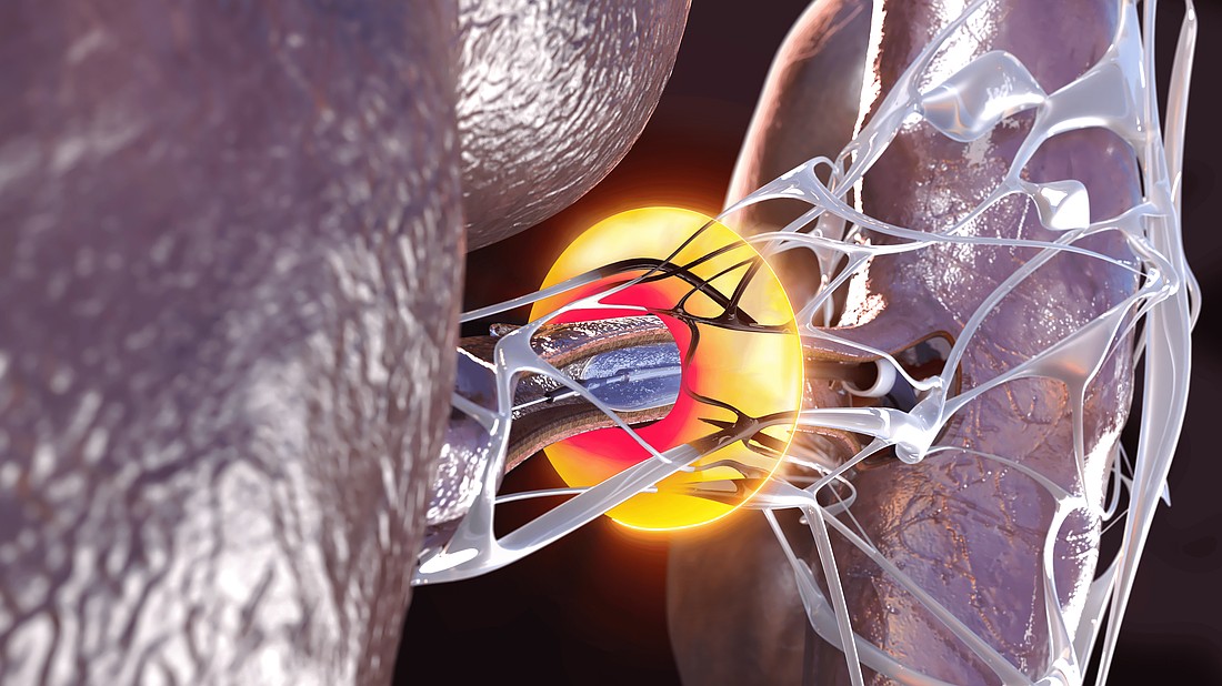 Ultrasound renal denervation is an outpatient procedure that calms overactive nerves from the kidneys. These nerves can cause hypertension, which can weaken the circulatory system and lead to heart attacks or strokes.