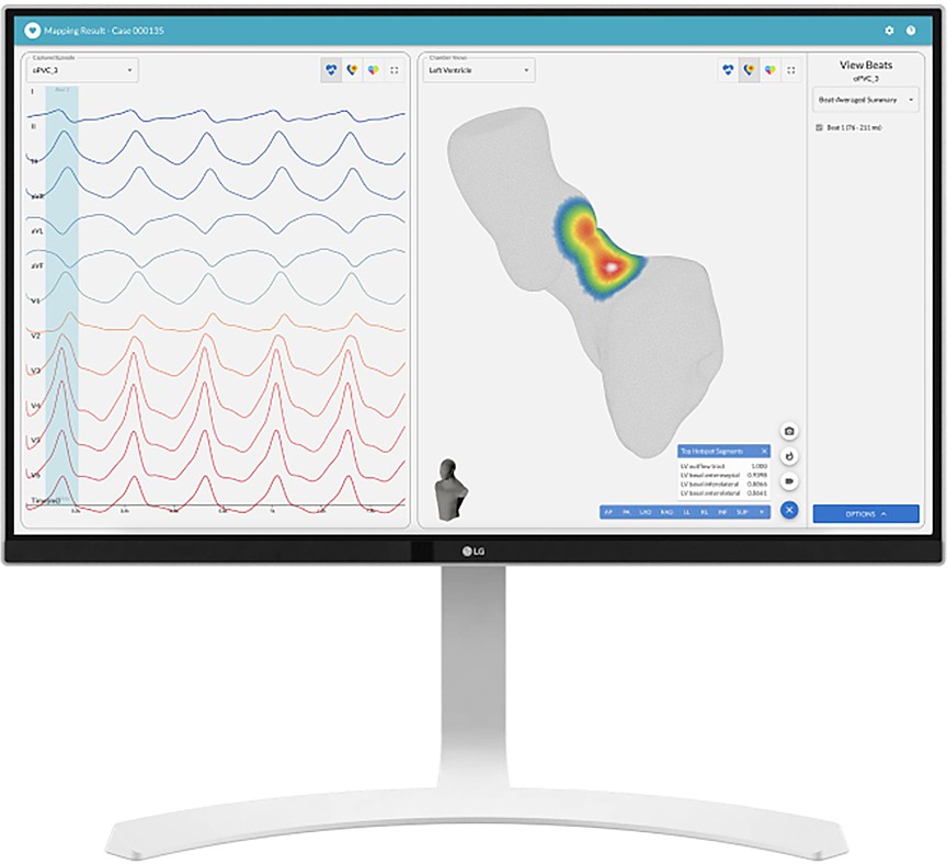 Testing has begun at Ascension St. Vincent’s to determine the accuracy of vMap, a noninvasive way to find the causes and location of AFib.