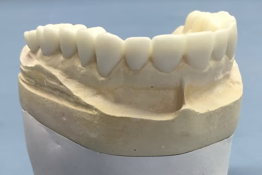 Brlit Dental Laboratory in Sarasota makes crowns, bridges, implants, dentures, partials and appliance repairs.