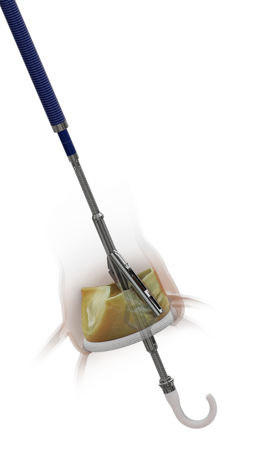 The ShortCut is used in a heart procedure called a Transcatheter Aortic Valve Replacement.