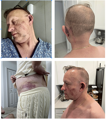 Hans Hamilton suffered from a brain bleed, four broken ribs and more due to the attack.