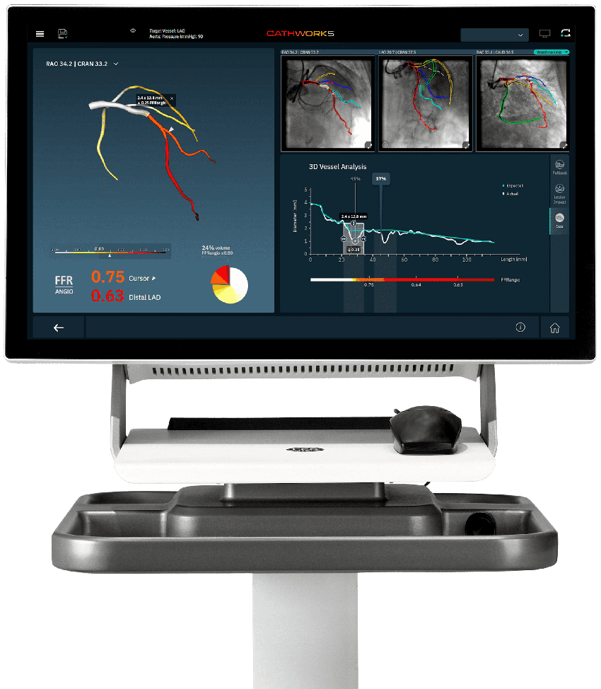 The CathWorks FFRangio System combines AI and advanced computational science to create a digital model of the coronary arteries.